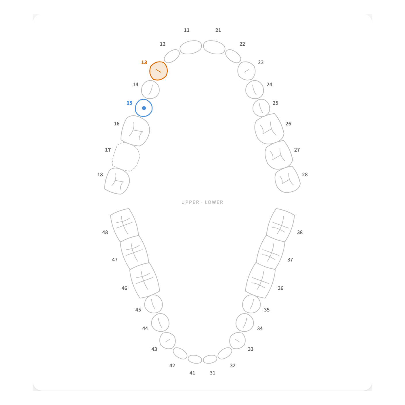 The dictated state: tooth 13 has decay, 15 has a filling, 17 is missing.